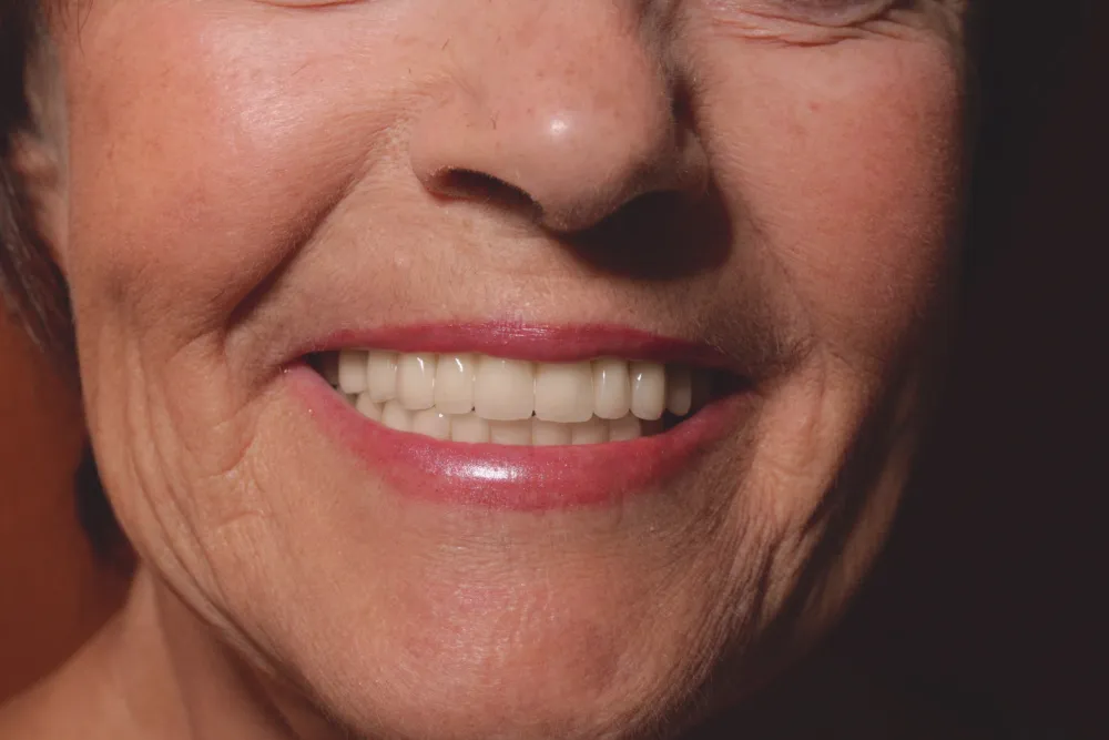 After — Dental implants and aesthetic restoration