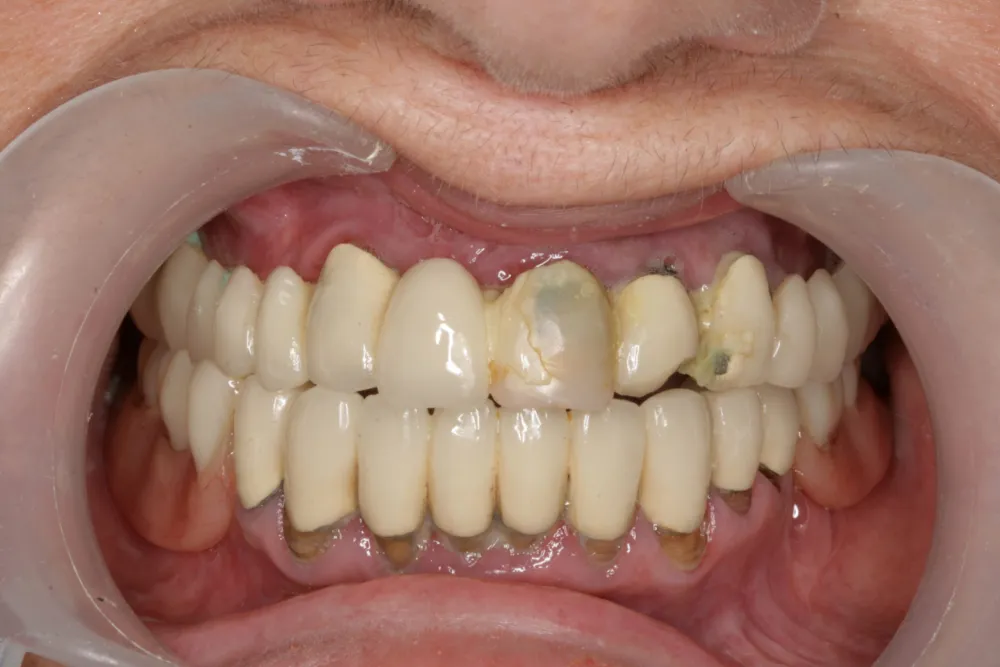 Before — Dental implants and aesthetic restoration